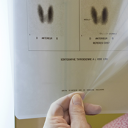 Cirurgia para remover tiroide, sem causar cicatriz no pescoço, mais acessível