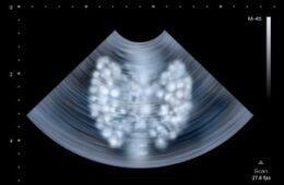 CIRURGIA NAS DOENÇAS DA TIROIDE